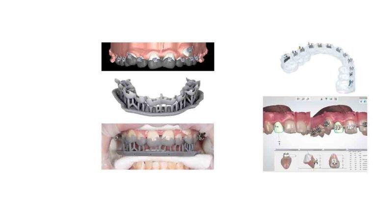 clear aligners 3D printed